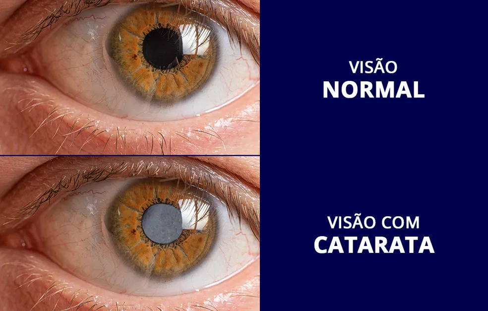 Cirurgia de Catarata